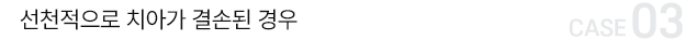 선천적으로 치아가 결손된 경우